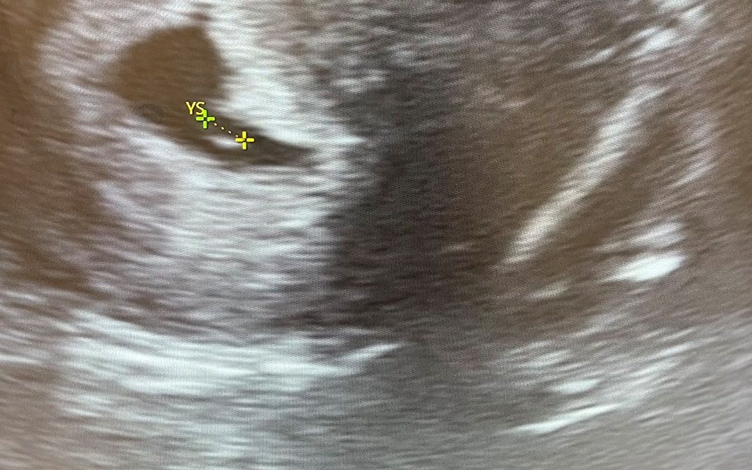 FIV cu ovocite donate la 44 de ani