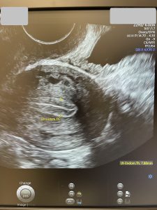 FIV cu ovocitele proprii