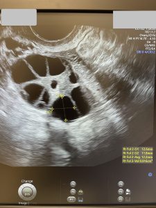 FIV cu ovocitele proprii