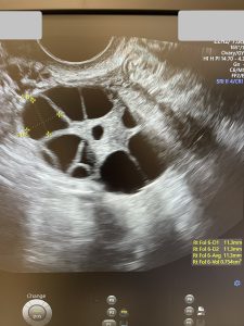 FIV cu ovocitele proprii