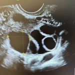 Fertilizarea in vitro