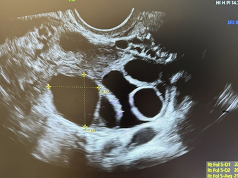 Fertilizarea in vitro