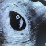 FIV fără trompe uterine
