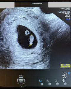 FIV fără trompe uterine