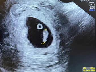 FIV fără trompe uterine