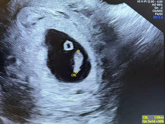 FIV fără trompe uterine