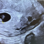 endometrioza și FIV