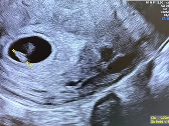 endometrioza și FIV