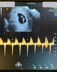 FIV fără trompe uterine